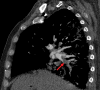 PE in a 73-year-old man with COVID-19. (a) Axial nonenhanced CT image
(lung window) at baseline shows peripherally diffuse ground-glass opacities
in both lungs. (b) Axial contrast-enhanced CT image (lung window) obtained
after 10 days shows increased consolidation in both lungs. Note the
bronchial dilatation within involved portions of the lungs. (c, d) Axial
contrast-enhanced CT image (mediastinal window) (c) and sagittal
reconstruction (d) obtained 10 days after the baseline images show a filling
defect (arrow) in a segmental pulmonary artery branch in the right lower
lobe, consistent with PE.
