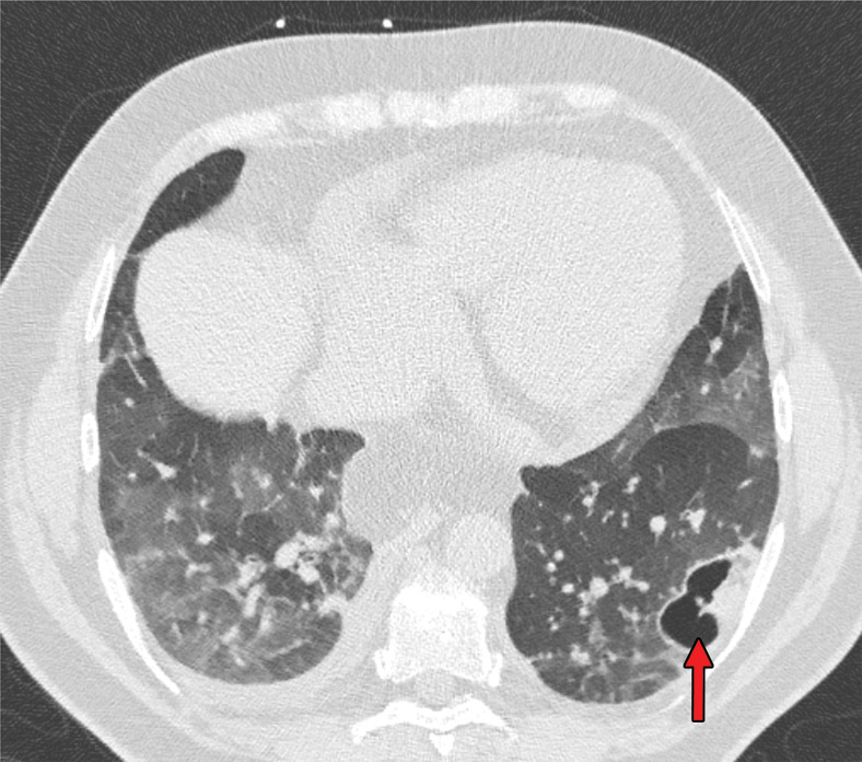 Development of cavitating lung lesions in a 47-year-old man with COVID-19. (a, b) Axial nonenhanced CT images (lung window) obtained at hospital admission show ground-glass opacities in both lungs (early progressive stage). (c, d) Axial nonenhanced CT images (lung window) obtained after 10 days show progressive organizing consolidation (peak stage). (e, f) Axial nonenhanced CT images (lung window) obtained 40 days after the baseline CT images (a, b) show cavitating lesions in both lower lobes (arrow) (late stage).