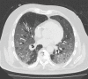 PE in a 73-year-old man with COVID-19. (a) Axial nonenhanced CT image
(lung window) at baseline shows peripherally diffuse ground-glass opacities
in both lungs. (b) Axial contrast-enhanced CT image (lung window) obtained
after 10 days shows increased consolidation in both lungs. Note the
bronchial dilatation within involved portions of the lungs. (c, d) Axial
contrast-enhanced CT image (mediastinal window) (c) and sagittal
reconstruction (d) obtained 10 days after the baseline images show a filling
defect (arrow) in a segmental pulmonary artery branch in the right lower
lobe, consistent with PE.