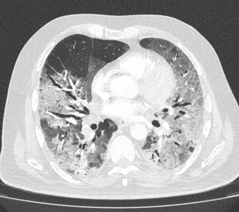 PE in a 73-year-old man with COVID-19. (a) Axial nonenhanced CT image (lung window) at baseline shows peripherally diffuse ground-glass opacities in both lungs. (b) Axial contrast-enhanced CT image (lung window) obtained after 10 days shows increased consolidation in both lungs. Note the bronchial dilatation within involved portions of the lungs. (c, d) Axial contrast-enhanced CT image (mediastinal window) (c) and sagittal reconstruction (d) obtained 10 days after the baseline images show a filling defect (arrow) in a segmental pulmonary artery branch in the right lower lobe, consistent with PE.