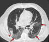 Superimposed pneumonia in a 69-year-old man with COVID-19. (a) Axial
nonenhanced CT image (lung window) at baseline shows ground-glass opacities
(arrows) posteriorly located in the left upper lobe and both lower lobes and
an area of consolidation (arrowhead) in the right lower lobe. (b) Axial
contrast-enhanced CT image (lung window) obtained after 22 days shows
increased consolidation in both lower lobes (red arrows) and consolidation
with central cavitation in the left upper lobe (yellow arrow). The culture
of puslike bronchial fluid was positive for Staphylococcus aureus. Note the
presence of pneumomediastinum (arrowhead), which is probably due to
long-lasting positive-pressure ventilation.