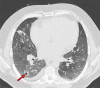 Development of cavitating lung lesions in a 47-year-old man with
COVID-19. (a, b) Axial nonenhanced CT images (lung window) obtained at
hospital admission show ground-glass opacities in both lungs (early
progressive stage). (c, d) Axial nonenhanced CT images (lung window)
obtained after 10 days show progressive organizing consolidation (peak
stage). (e, f) Axial nonenhanced CT images (lung window) obtained 40 days
after the baseline CT images (a, b) show cavitating lesions in both lower
lobes (arrow) (late stage).