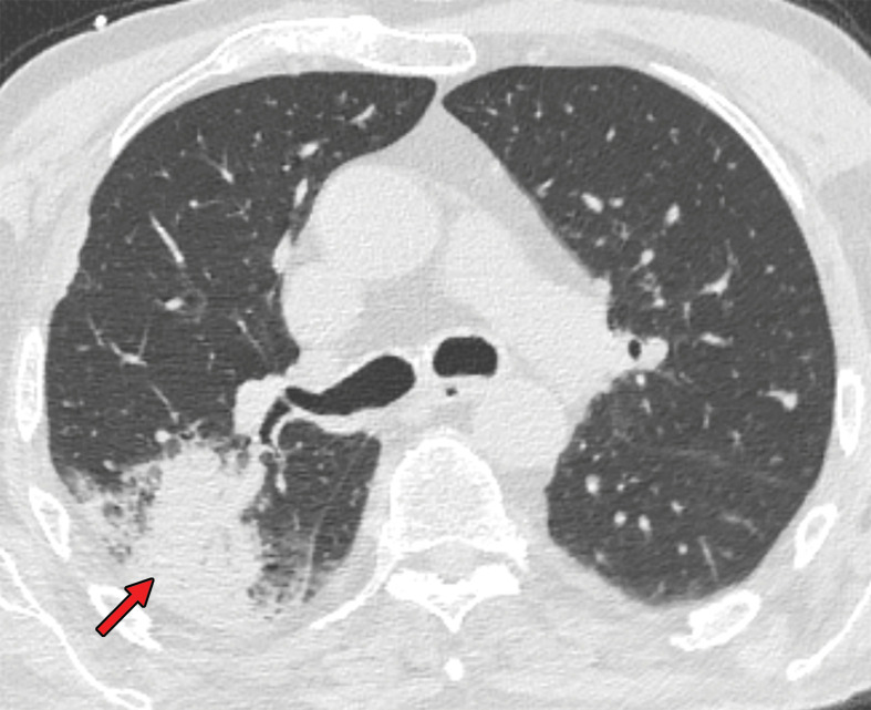 Mixed chest CT findings in an 86-year-old man. (a) Axial nonenhanced CT image (lung window) obtained at hospital admission shows sublobar consolidation (arrow) in the posterior segment of the right upper lobe, a finding more consistent with lobar pneumonia than COVID-19. (b) Axial CT image obtained at a more superior level shows the presence of ground-glass opacities (arrows). Altogether, the findings were classified as indeterminate for COVID-19 pneumonia, according to the RSNA chest CT classification system (51). The RT-PCR test results were positive for SARS-CoV-2.