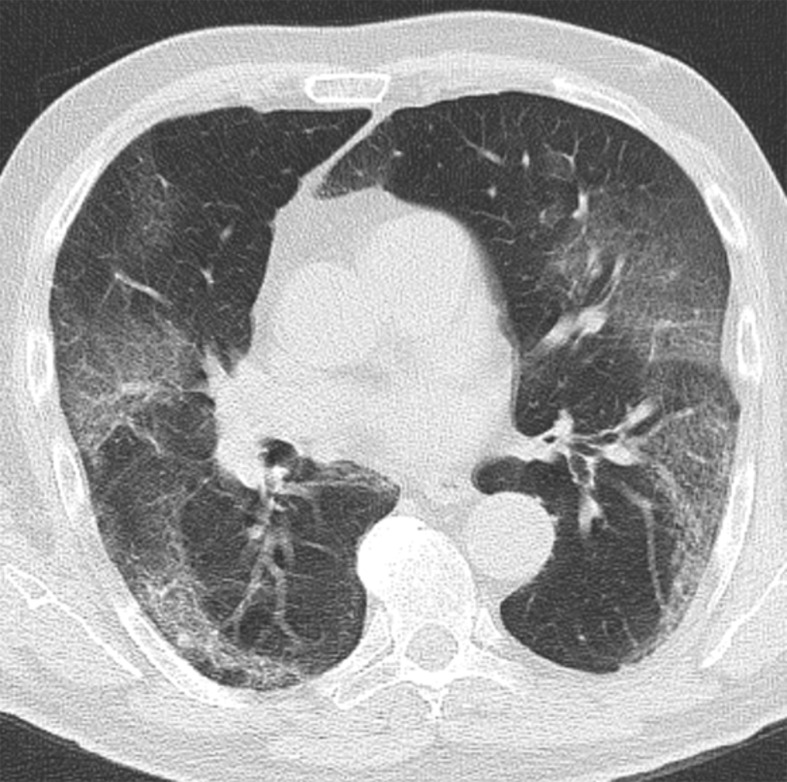 Occurrence of lung fibrosis in a 75-year-old man with COVID-19. (a) Axial nonenhanced CT image (lung window) obtained at hospital admission shows bilateral ground-glass opacities, which are mainly peripherally located. (b) Axial contrast-enhanced CT image (lung window) obtained after 8 weeks shows bilateral curvilinear parenchymal bands with distortion of lung architecture. Focal traction bronchiectasis (not shown) also manifested.