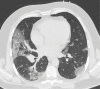 Development of cavitating lung lesions in a 47-year-old man with
COVID-19. (a, b) Axial nonenhanced CT images (lung window) obtained at
hospital admission show ground-glass opacities in both lungs (early
progressive stage). (c, d) Axial nonenhanced CT images (lung window)
obtained after 10 days show progressive organizing consolidation (peak
stage). (e, f) Axial nonenhanced CT images (lung window) obtained 40 days
after the baseline CT images (a, b) show cavitating lesions in both lower
lobes (arrow) (late stage).