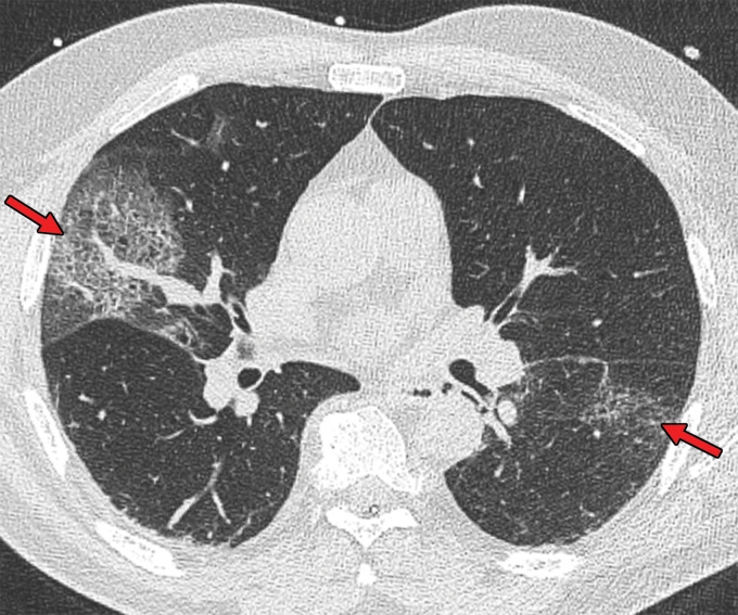 Crazy-paving pattern in a 66-year-old man with COVID-19. Axial nonenhanced chest CT image shows ground-glass opacities, with superimposed septal thickening (arrows) in the middle lobe and left lower lobe.