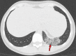 Findings classified as indeterminate appearance of COVID-19 pneumonia in a
26-year-old woman. Axial nonenhanced chest CT image (lung window) shows an area
of ground-glass opacity (arrow) in the posterior basal segment of the left lower
lobe. No other lung abnormalities were visualized. The RT-PCR test results were
positive for SARS-CoV-2.
