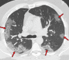 COVID-19 pneumonia with typical imaging features according to the
Radiological Society of North America (RSNA) chest CT classification system
(51). Axial nonenhanced chest CT images (lung window) in a 59-year-old man
(a) and a 47-year-old man (b), each with positive RT-PCR test results for
SARS-CoV-2, show bilateral areas of ground-glass opacities (arrows) in a
peripheral distribution.