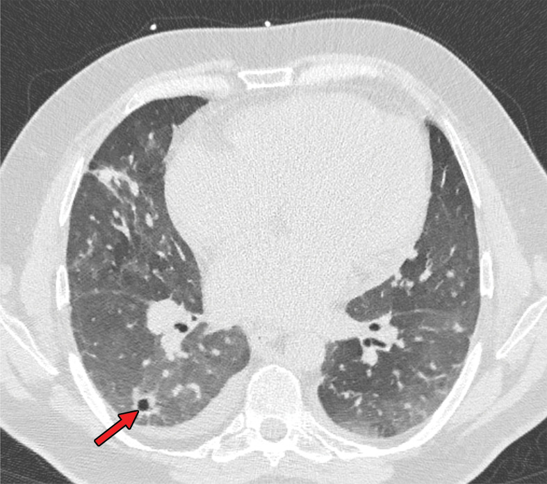 Development of cavitating lung lesions in a 47-year-old man with COVID-19. (a, b) Axial nonenhanced CT images (lung window) obtained at hospital admission show ground-glass opacities in both lungs (early progressive stage). (c, d) Axial nonenhanced CT images (lung window) obtained after 10 days show progressive organizing consolidation (peak stage). (e, f) Axial nonenhanced CT images (lung window) obtained 40 days after the baseline CT images (a, b) show cavitating lesions in both lower lobes (arrow) (late stage).