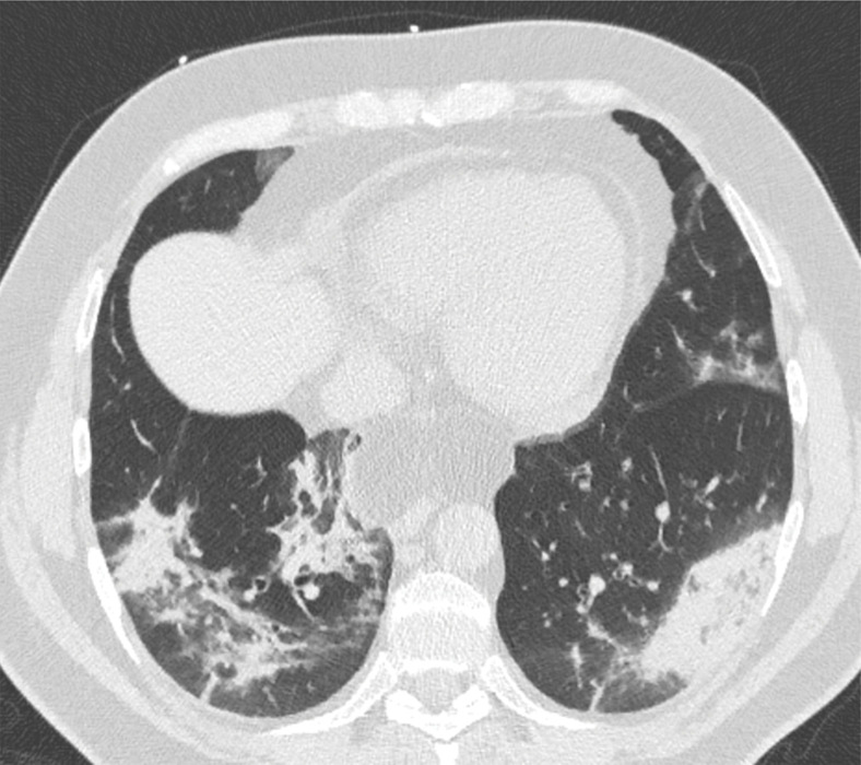 Development of cavitating lung lesions in a 47-year-old man with COVID-19. (a, b) Axial nonenhanced CT images (lung window) obtained at hospital admission show ground-glass opacities in both lungs (early progressive stage). (c, d) Axial nonenhanced CT images (lung window) obtained after 10 days show progressive organizing consolidation (peak stage). (e, f) Axial nonenhanced CT images (lung window) obtained 40 days after the baseline CT images (a, b) show cavitating lesions in both lower lobes (arrow) (late stage).