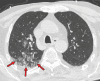 Mixed chest CT findings in an 86-year-old man. (a) Axial nonenhanced CT
image (lung window) obtained at hospital admission shows sublobar consolidation
(arrow) in the posterior segment of the right upper lobe, a finding more
consistent with lobar pneumonia than COVID-19. (b) Axial CT image obtained at a
more superior level shows the presence of ground-glass opacities (arrows).
Altogether, the findings were classified as indeterminate for COVID-19
pneumonia, according to the RSNA chest CT classification system (51). The RT-PCR
test results were positive for SARS-CoV-2.