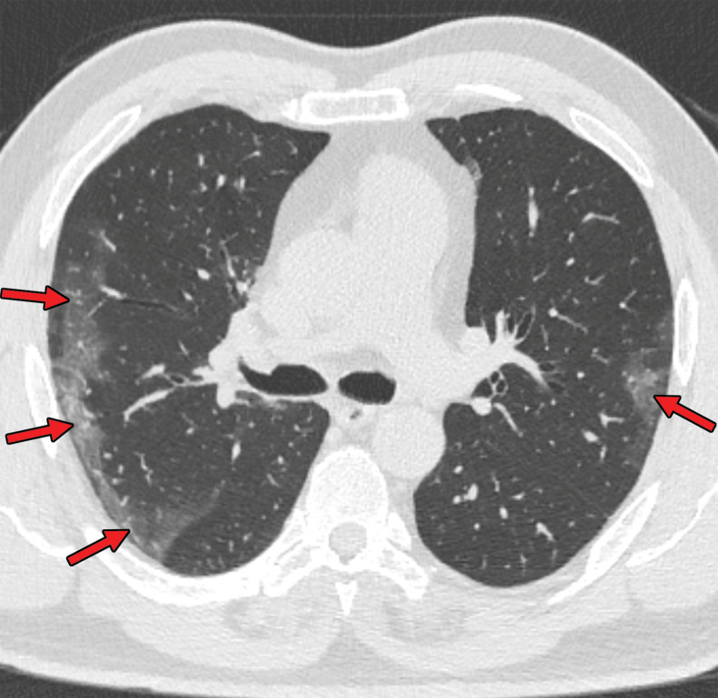 COVID-19 pneumonia with typical imaging features according to the Radiological Society of North America (RSNA) chest CT classification system (51). Axial nonenhanced chest CT images (lung window) in a 59-year-old man (a) and a 47-year-old man (b), each with positive RT-PCR test results for SARS-CoV-2, show bilateral areas of ground-glass opacities (arrows) in a peripheral distribution.