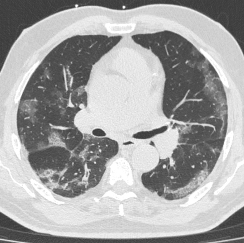 Transition from progressive stage to peak stage in a 69-year-old man with COVID-19. (a) Axial nonenhanced chest CT image (lung window) obtained at hospital admission shows bilateral areas of ground-glass opacities and crazy-paving appearance. (b) Axial contrast-enhanced chest CT image (lung window) obtained after 7 days shows progression from ground-glass opacities to multifocal organizing consolidation.