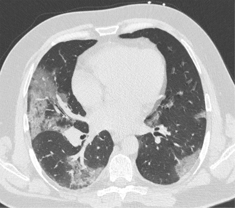 Development of cavitating lung lesions in a 47-year-old man with COVID-19. (a, b) Axial nonenhanced CT images (lung window) obtained at hospital admission show ground-glass opacities in both lungs (early progressive stage). (c, d) Axial nonenhanced CT images (lung window) obtained after 10 days show progressive organizing consolidation (peak stage). (e, f) Axial nonenhanced CT images (lung window) obtained 40 days after the baseline CT images (a, b) show cavitating lesions in both lower lobes (arrow) (late stage).