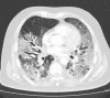 PE in a 73-year-old man with COVID-19. (a) Axial nonenhanced CT image
(lung window) at baseline shows peripherally diffuse ground-glass opacities
in both lungs. (b) Axial contrast-enhanced CT image (lung window) obtained
after 10 days shows increased consolidation in both lungs. Note the
bronchial dilatation within involved portions of the lungs. (c, d) Axial
contrast-enhanced CT image (mediastinal window) (c) and sagittal
reconstruction (d) obtained 10 days after the baseline images show a filling
defect (arrow) in a segmental pulmonary artery branch in the right lower
lobe, consistent with PE.