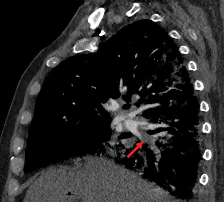 PE in a 73-year-old man with COVID-19. (a) Axial nonenhanced CT image (lung window) at baseline shows peripherally diffuse ground-glass opacities in both lungs. (b) Axial contrast-enhanced CT image (lung window) obtained after 10 days shows increased consolidation in both lungs. Note the bronchial dilatation within involved portions of the lungs. (c, d) Axial contrast-enhanced CT image (mediastinal window) (c) and sagittal reconstruction (d) obtained 10 days after the baseline images show a filling defect (arrow) in a segmental pulmonary artery branch in the right lower lobe, consistent with PE.