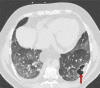 Development of cavitating lung lesions in a 47-year-old man with
COVID-19. (a, b) Axial nonenhanced CT images (lung window) obtained at
hospital admission show ground-glass opacities in both lungs (early
progressive stage). (c, d) Axial nonenhanced CT images (lung window)
obtained after 10 days show progressive organizing consolidation (peak
stage). (e, f) Axial nonenhanced CT images (lung window) obtained 40 days
after the baseline CT images (a, b) show cavitating lesions in both lower
lobes (arrow) (late stage).
