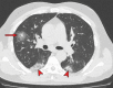 Halo sign in a 55-year-old man with RT-PCR-test–proven
COVID-19. Axial nonenhanced chest CT images show consolidations surrounded
by ground-glass opacities (arrows) in both upper lobes, findings consistent
with the halo sign. There is a ground-glass opacity in the right upper lobe
(arrowhead in a) and consolidation in both lower lobes (arrowheads in
b).