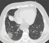 Development of cavitating lung lesions in a 47-year-old man with
COVID-19. (a, b) Axial nonenhanced CT images (lung window) obtained at
hospital admission show ground-glass opacities in both lungs (early
progressive stage). (c, d) Axial nonenhanced CT images (lung window)
obtained after 10 days show progressive organizing consolidation (peak
stage). (e, f) Axial nonenhanced CT images (lung window) obtained 40 days
after the baseline CT images (a, b) show cavitating lesions in both lower
lobes (arrow) (late stage).
