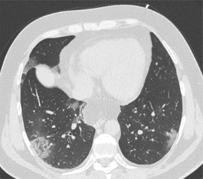 Development of cavitating lung lesions in a 47-year-old man with COVID-19. (a, b) Axial nonenhanced CT images (lung window) obtained at hospital admission show ground-glass opacities in both lungs (early progressive stage). (c, d) Axial nonenhanced CT images (lung window) obtained after 10 days show progressive organizing consolidation (peak stage). (e, f) Axial nonenhanced CT images (lung window) obtained 40 days after the baseline CT images (a, b) show cavitating lesions in both lower lobes (arrow) (late stage).