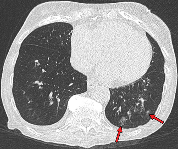 Findings classified as atypical appearance of COVID-19 pneumonia in a 94-year-old woman. Axial nonenhanced chest CT image (lung window) shows subtle centrilobular tree-in-bud opacities (arrows) in the left lower lobe. The RT-PCR test results were negative for SARS-CoV-2 but positive for influenza type A.