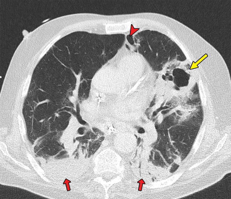 Superimposed pneumonia in a 69-year-old man with COVID-19. (a) Axial nonenhanced CT image (lung window) at baseline shows ground-glass opacities (arrows) posteriorly located in the left upper lobe and both lower lobes and an area of consolidation (arrowhead) in the right lower lobe. (b) Axial contrast-enhanced CT image (lung window) obtained after 22 days shows increased consolidation in both lower lobes (red arrows) and consolidation with central cavitation in the left upper lobe (yellow arrow). The culture of puslike bronchial fluid was positive for Staphylococcus aureus. Note the presence of pneumomediastinum (arrowhead), which is probably due to long-lasting positive-pressure ventilation.