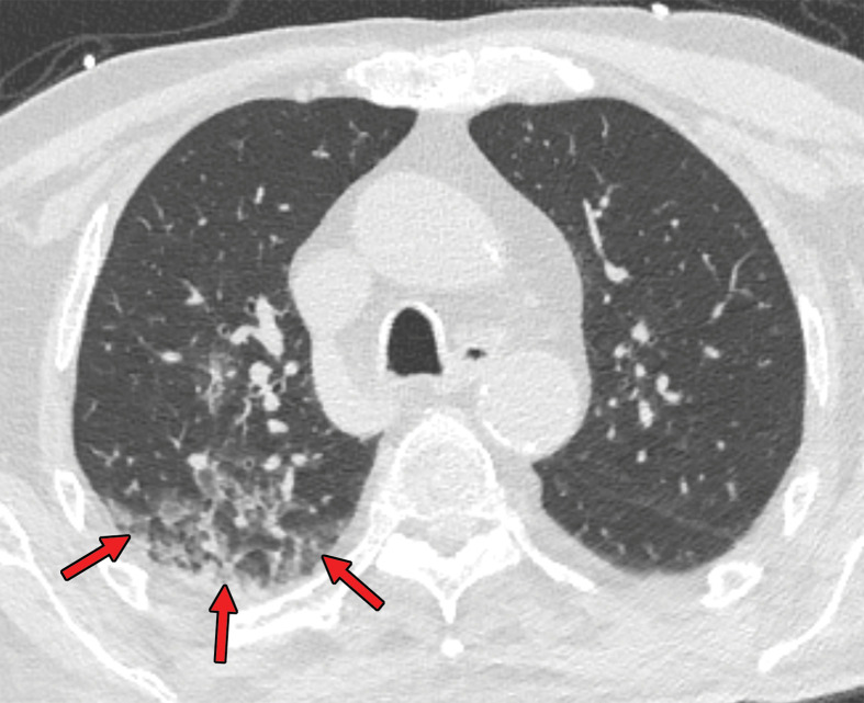 Mixed chest CT findings in an 86-year-old man. (a) Axial nonenhanced CT image (lung window) obtained at hospital admission shows sublobar consolidation (arrow) in the posterior segment of the right upper lobe, a finding more consistent with lobar pneumonia than COVID-19. (b) Axial CT image obtained at a more superior level shows the presence of ground-glass opacities (arrows). Altogether, the findings were classified as indeterminate for COVID-19 pneumonia, according to the RSNA chest CT classification system (51). The RT-PCR test results were positive for SARS-CoV-2.