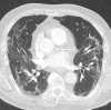 Occurrence of lung fibrosis in a 75-year-old man with COVID-19. (a)
Axial nonenhanced CT image (lung window) obtained at hospital admission
shows bilateral ground-glass opacities, which are mainly peripherally
located. (b) Axial contrast-enhanced CT image (lung window) obtained after 8
weeks shows bilateral curvilinear parenchymal bands with distortion of lung
architecture. Focal traction bronchiectasis (not shown) also
manifested.