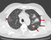 Halo sign in a 55-year-old man with RT-PCR-test–proven
COVID-19. Axial nonenhanced chest CT images show consolidations surrounded
by ground-glass opacities (arrows) in both upper lobes, findings consistent
with the halo sign. There is a ground-glass opacity in the right upper lobe
(arrowhead in a) and consolidation in both lower lobes (arrowheads in
b).