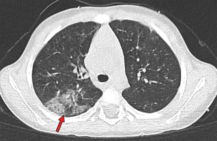 Findings classified as indeterminate appearance of COVID-19 pneumonia according to the RSNA chest CT classification system (51) in a 24-year-old woman. Axial nonenhanced chest CT image (lung window) shows ground-glass opacities (arrow) in the right upper lobe. In addition, there are discrete centrilobular opacities in the upper lobes. The RT-PCR test results were negative for SARS-CoV-2 but positive for influenza type A.