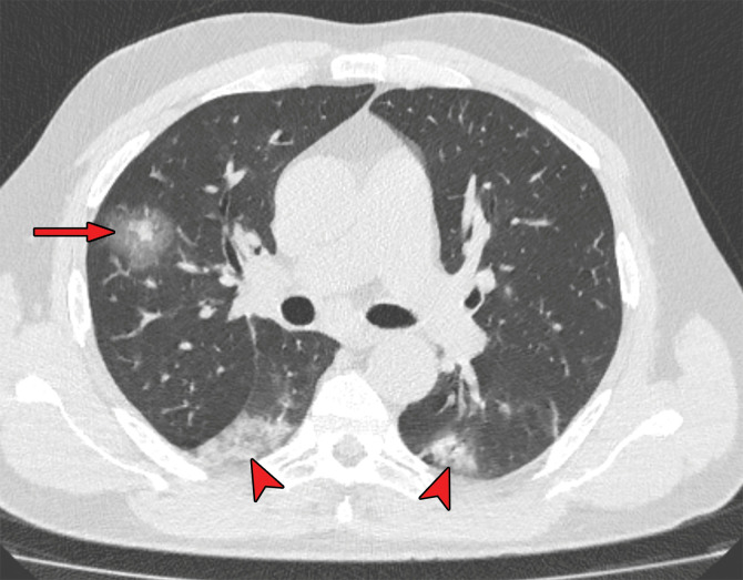 Halo sign in a 55-year-old man with RT-PCR-test–proven COVID-19. Axial nonenhanced chest CT images show consolidations surrounded by ground-glass opacities (arrows) in both upper lobes, findings consistent with the halo sign. There is a ground-glass opacity in the right upper lobe (arrowhead in a) and consolidation in both lower lobes (arrowheads in b).