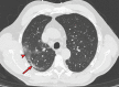 Chest CT abnormalities of relatively intermediate prevalence in
COVID-19, shown in a 63-year-old man with positive RT-PCR test results for
SARS-CoV-2. Axial nonenhanced chest CT image shows a subpleural curvilinear
opacity (arrow) and an area of ground-glass opacity (arrowhead) in the right
upper lobe.