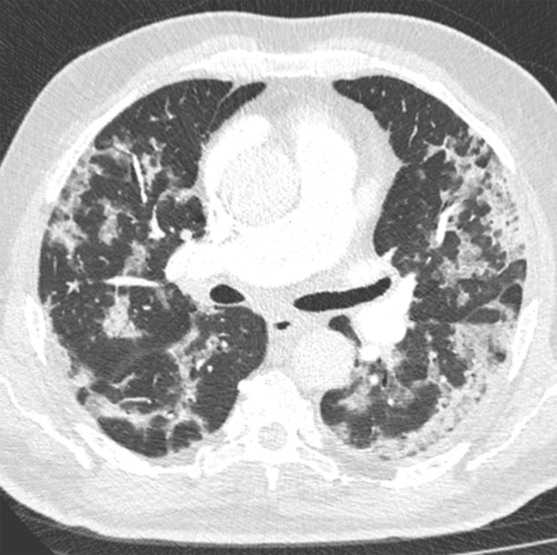 Transition from progressive stage to peak stage in a 69-year-old man with COVID-19. (a) Axial nonenhanced chest CT image (lung window) obtained at hospital admission shows bilateral areas of ground-glass opacities and crazy-paving appearance. (b) Axial contrast-enhanced chest CT image (lung window) obtained after 7 days shows progression from ground-glass opacities to multifocal organizing consolidation.