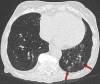 Findings classified as atypical appearance of COVID-19 pneumonia in a
94-year-old woman. Axial nonenhanced chest CT image (lung window) shows subtle
centrilobular tree-in-bud opacities (arrows) in the left lower lobe. The RT-PCR
test results were negative for SARS-CoV-2 but positive for influenza type
A.