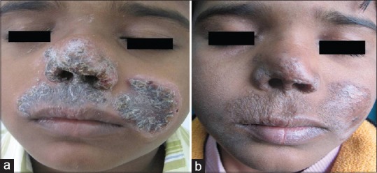 Lupus vulgaris leading to perforation of nasal septum in a child - PMC