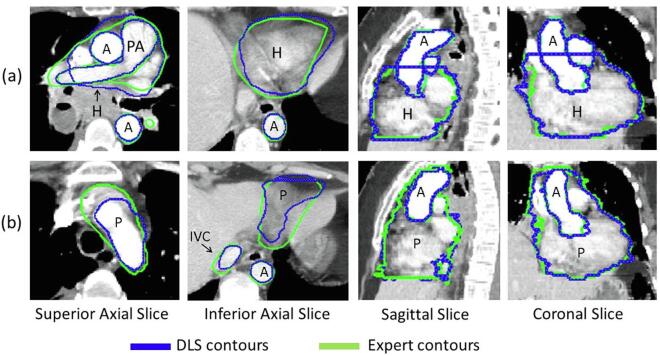 Comparison between expert contours (in green) and auto-generated DLS contours (in blue) for the (a) Heart and the (b) Pericardium, and the surrounding PA, IVC and Aorta structures for the worst performing patient. The first two columns display the superior and the inferior axial slices pertaining to the beginning and the end of the anatomical structures. H: Heart, P: Pericardium, PA: Pulmonary Artery, IVC: Inferior Vena Cava, A: Aorta.