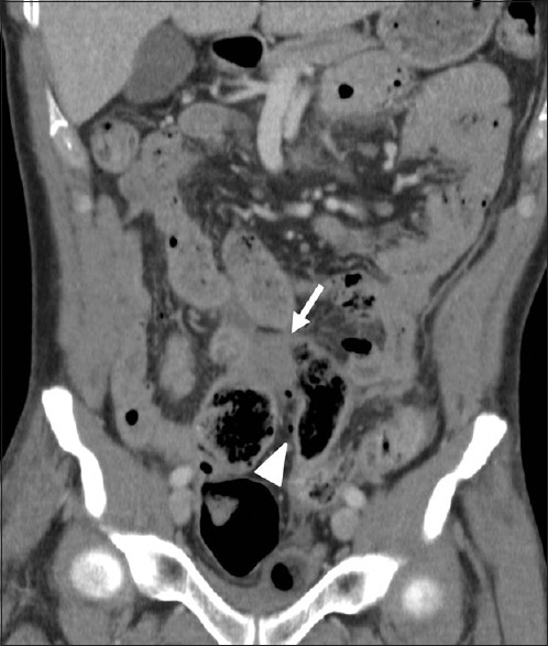 Bowel and mesenteric injuries in blunt abdominal injury - PMC