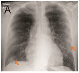 A. Portable Chest Radiograph in a RT-PCR (+) Patient with COVID-19. There are bilateral ill-defined opacities (arrows) in a lower lung predominant distribution. B. Chest CTA Pulmonary Embolus Scan of a RT-PCR (+) Patient with COVID-19. Axial image demonstrating bilateral peripheral ground glass opacities and consolidation (arrows). No pulmonary embolus was detected.