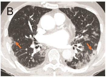 A. Portable Chest Radiograph in a RT-PCR (+) Patient with COVID-19. There are bilateral ill-defined opacities (arrows) in a lower lung predominant distribution. B. Chest CTA Pulmonary Embolus Scan of a RT-PCR (+) Patient with COVID-19. Axial image demonstrating bilateral peripheral ground glass opacities and consolidation (arrows). No pulmonary embolus was detected.