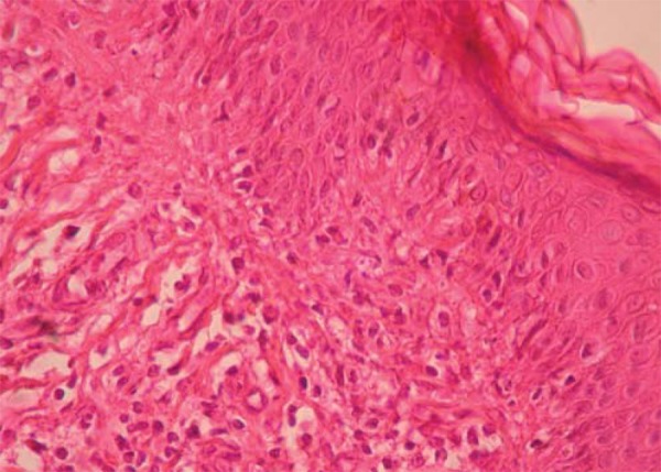 Dermoscopy of lichen aureus - PMC