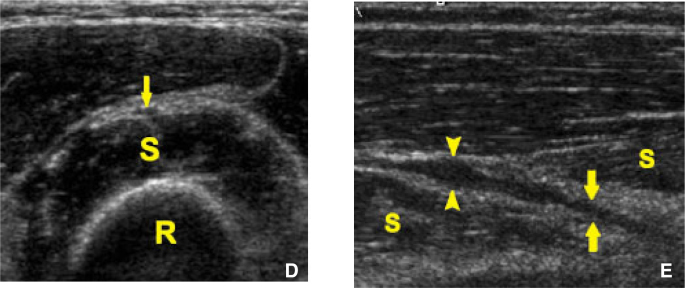 Figure 1E