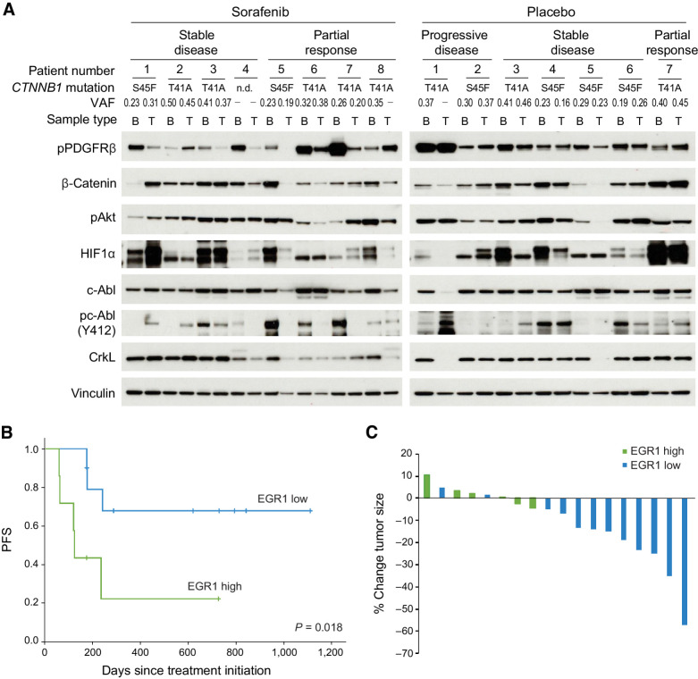 Figure 5. Inhibition of PDGFRβ/c-Abl signaling may correlate with response to sorafenib in desmoid patients. A, Activation of PDGFRβ, c-Abl, and Akt and expression of HIF1α and β-catenin as detected by immunoblot in baseline (B) and post-treatment (T) biopsies in individual patients treated on the placebo and sorafenib arms of Alliance A091105. Best response (partial response, stable or progressive disease) as assayed by RECIST criteria or clinical progression, CTNNB1 mutations and their variant allele frequencies (VAF; identified by RNA-seq) are annotated. Samples with no mutations detected are annotated (-). B, PFS defined by clinical progression or radiographic increase in size (>15% above baseline) in patients and stratified according to high (≥50% of desmoid cells) or low (<50% of cells positive) levels of nuclear EGR1 staining on IHC of baseline samples obtained from patients in the placebo arm of the trial. C, Percent change in tumor size after four to five cycles of sorafenib in patients on Alliance A091105. Tumors with ≥90% cells staining for nuclear EGR1 are designated as EGR1 high as opposed to low.