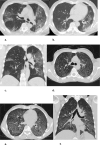 Example chest CT scans of patients with a true positive (case 3) and false positive (case 4) CO-RADS 5 score. (case 3) True positive CO-RADS 5 chest CT: two axial slices (a,b) and a coronal slice (c) of a 69-year-old male with 7 days of symptoms. CT shows bilateral multifocal areas of groundglass and consolidation in vicinity of the visceral pleural surface. Also, few thickened vessels in areas of groundglass are observed. Coronavirus disease 2019 was RT-PCR confirmed. (case 4) False positive CO-RADS 5 chest CT: two axial slices (d,e) and a coronal slice (f) of a 42-year-old male with more than 7 days of symptoms. CT shows diffuse groundglass opacities in the close vicinity of visceral pleural surfaces. Also, a crazy paving pattern is observed. RT-PCR for SARS-CoV2 was negative, and a diagnosis of pneumocystis jirovecii pneumonia was made based on bronchoalveolar lavage fluid.