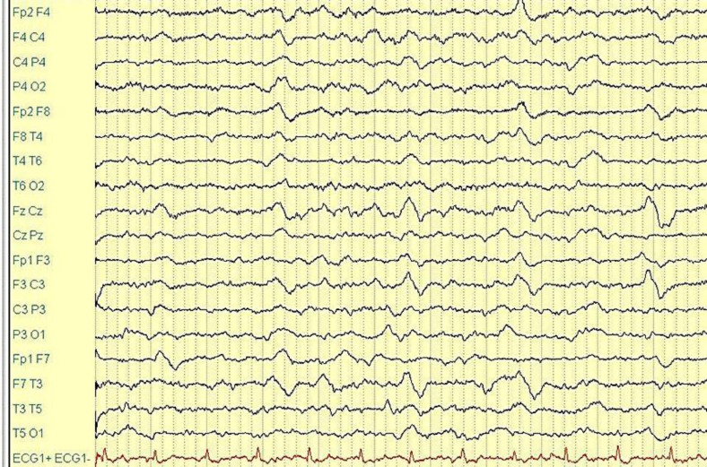 possessed-acute-confusional-migraine-in-an-adolescent-prevented-by