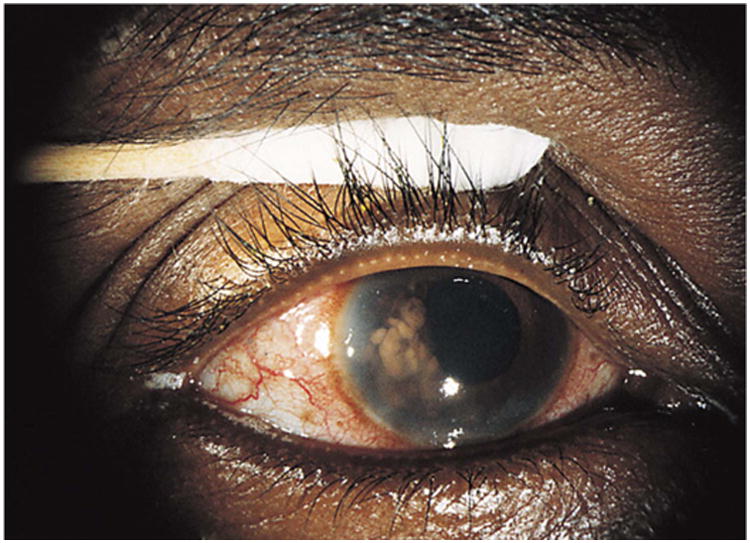 Ocular Tuberculosis - PMC