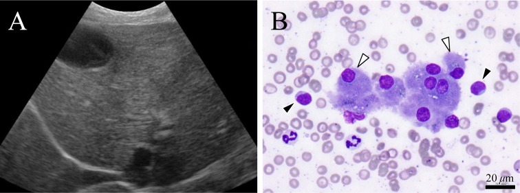 A case of prostate B-cell lymphoma recognized in the contents of an ...