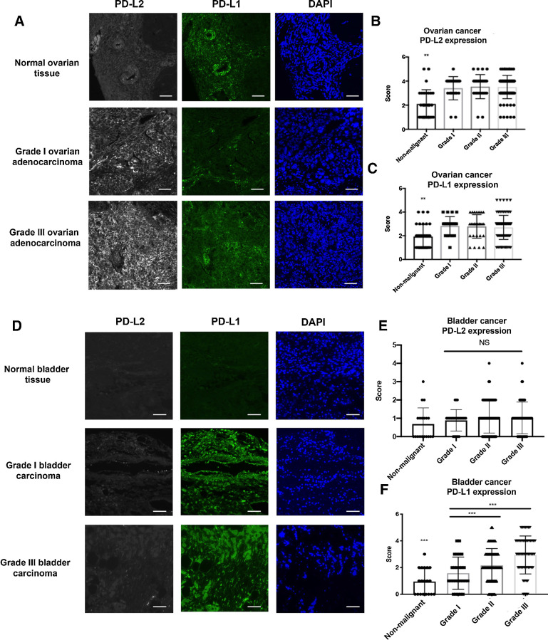 Figure 1. PD-L2 and PD-L1 expression in ovarian and bladder cancer. A, Representative images of ovarian cancer tissue microarray containing both normal and malignant samples (N = 156) stained with anti-human PD-L2 (gray), anti-human PD-L1 (green), and DAPI (blue) by fluorescent IHC. Scale bar 50 μm. The intensity of PD-L2 (B) and PD-L1 (C) were scored and stratified according to tumor grades. D, Bladder cancer tissue microarray was stained with anti-human PD-L2 (gray), anti-human PD-L1 (green), and DAPI (blue) by fluorescent IHC with representative images shown (N = 208). Scale bar 50 μm. E, PD-L2 expression in bladder cancer TMAs were scored and quantified according to tumor grade. F, PD-L1 expression in bladder cancer TMAs were scored and quantified according to tumor grade. Quantification data were plotted with mean and SD calculated. One-way ANOVA was used for analysis comparing the tumor grades. *, P < 0.05; **, P < 0.01; and ***, P < 0.001.