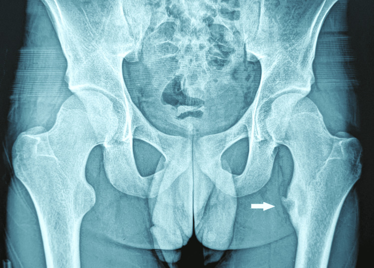 An Atypical Presentation of an Osteoid Osteoma of the Lesser Trochanter ...