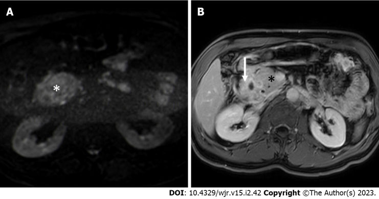 Imaging of paraduodenal pancreatitis: A systematic review - PMC