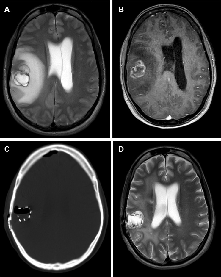 Preoperative and postoperative images in a 55-year-old female patient with IDH-wildtype glioblastoma. (A) Axial T2-weighted preoperative image and (B) T1-weighted postcontrast image demonstrate a large necrotic mass with surrounding T2-weighted fluid-attenuated inversion recovery hyperintense signal abnormality in the right parietal lobe with mass effect causing leftward midline shift. (C) Axial postoperative bone window CT scan and (D) axial T2-weighted image show evenly spaced radiation seeds (GammaTiles) outlining the resection cavity.